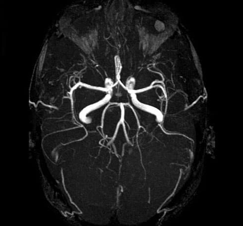 Brain Arterial Angio MRI