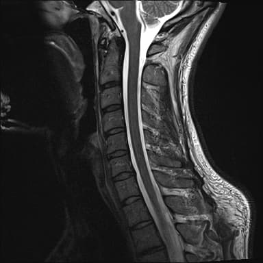Cervical MRI