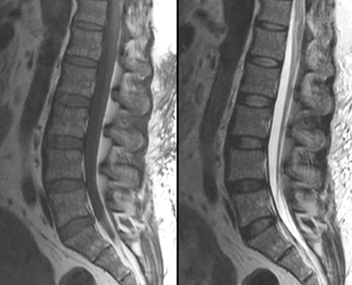 Lumbar MRI