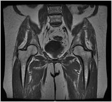 Lower Abdomen MRI