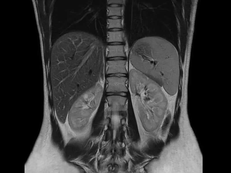 Upper Abdominal MRI