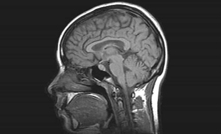 Pituitary MRI