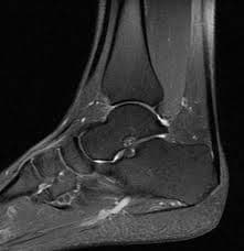 Ankle MRI
