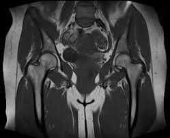 Hip MRI