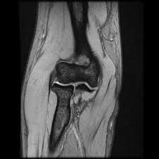 Elbow MRI