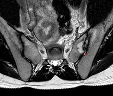 Sacroiliac MRI