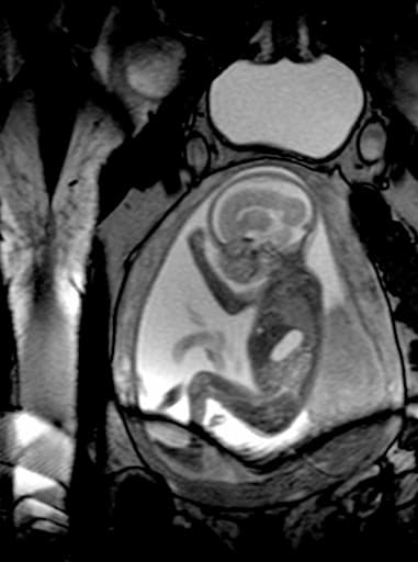 Fetal MRI