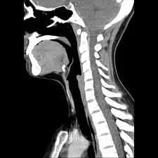 Cervical CT Scan