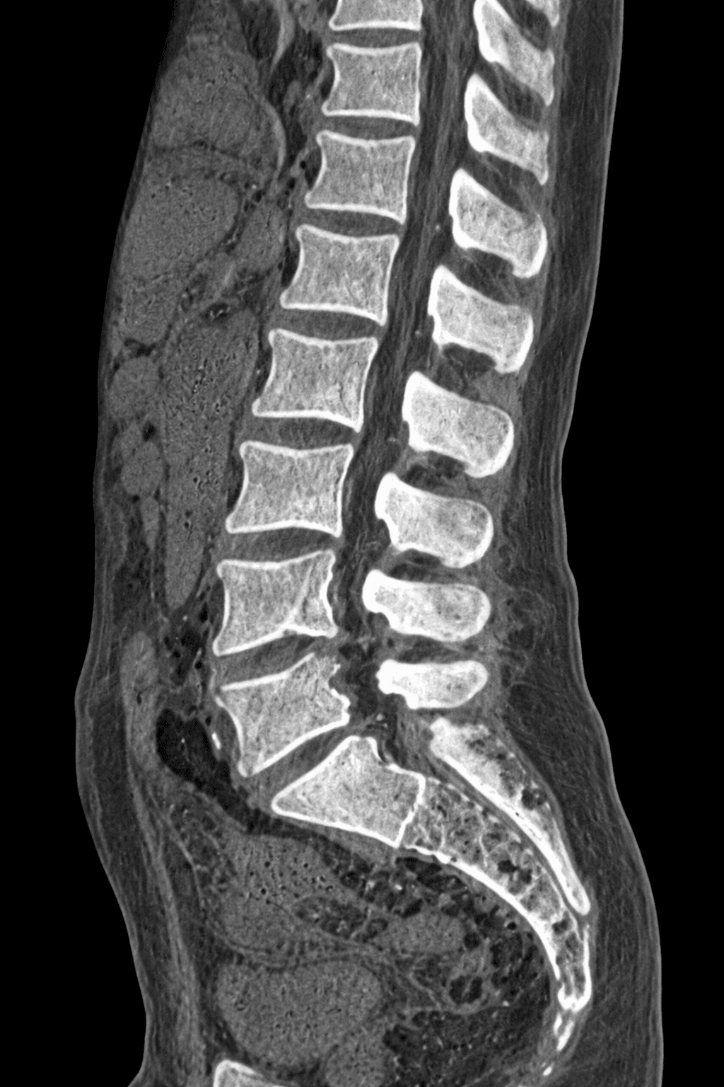 Lumbar CT Scan
