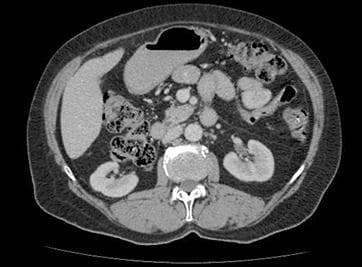 Upper Abdomen CT Scan
