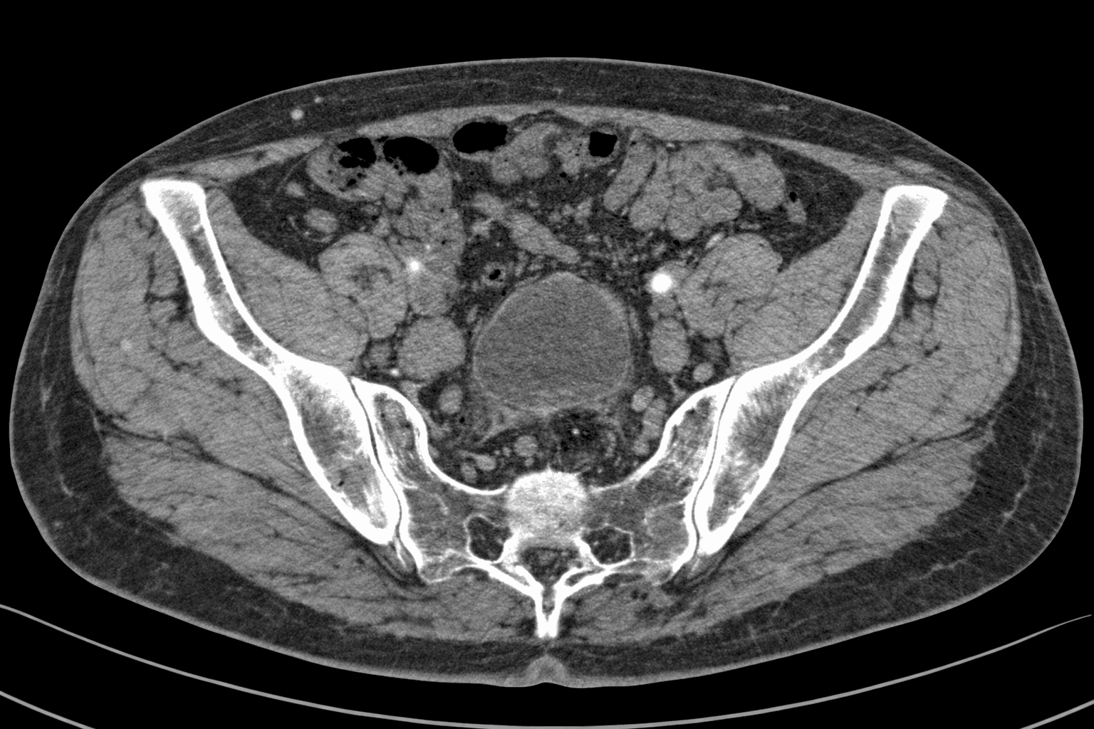 Lower Abdomen CT Scan