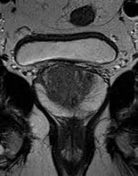 Multiparametric Prostate MRI