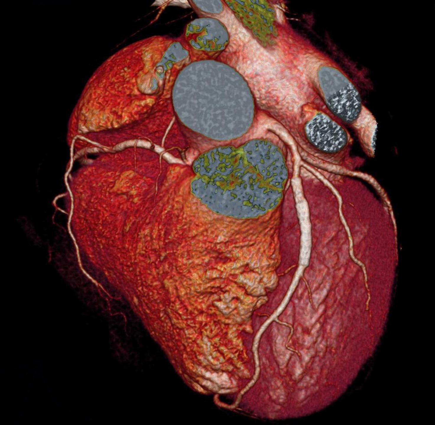 Coronary Cardiac CT Angiography