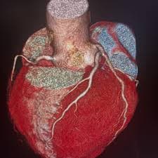 Coronary CT Angiography