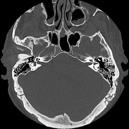 Temporal Bone CT Scan